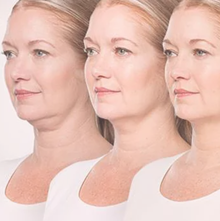 face-neck-fat-reducing-treatment-sunderland