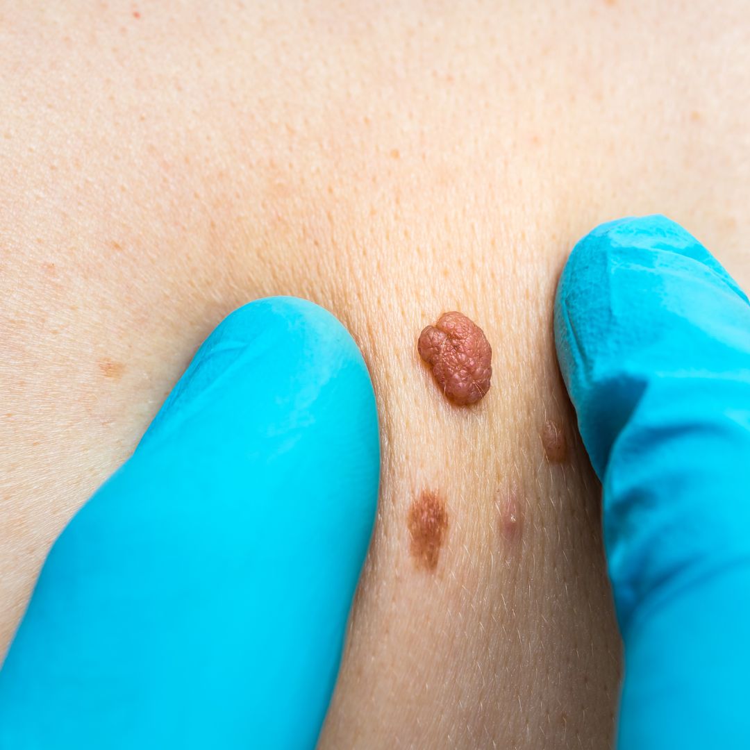 Moles, Warts, Skin Tags and Benign Growths