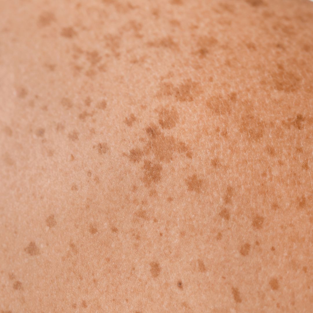 Pigmentation (Age spots, brown spots)